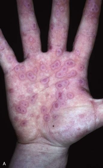 Image result for Rash Algorithm