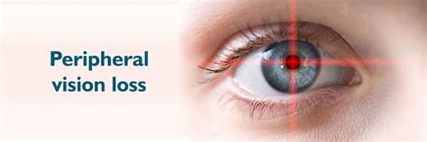 Perdita della visione periferica: cause, impatto e trattamento