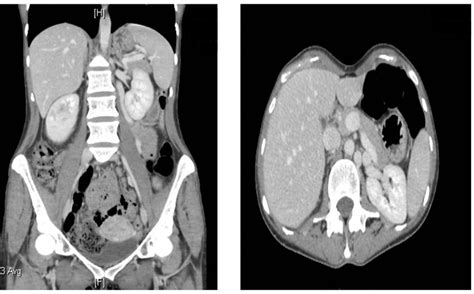 Left renal vein entrapment syndrome: nutcracker syndrome! | BMJ Case Reports
