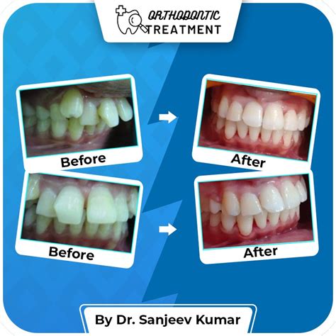 Orthodontics | Dental Square | Best dentist and dental clinic in Roorkee