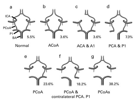 Anomalous vertebral and posterior communicating arteries as a risk factor in instrumentation of ...