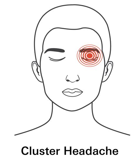 Types of Headaches and How To Treat Them