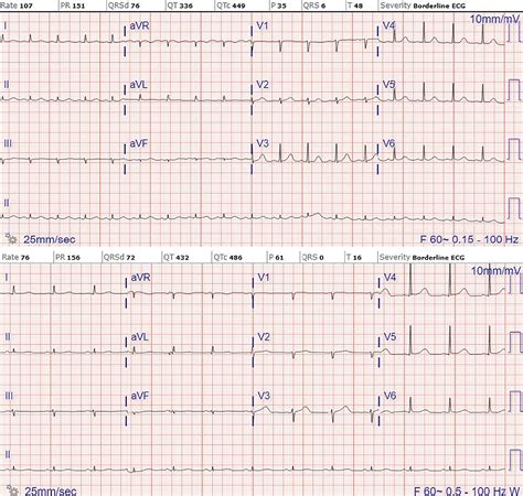 Micturition Syncope…Not Always Benign | Circulation