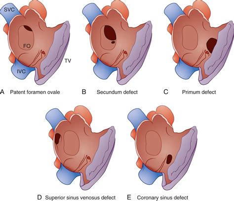 Atrial Septal Defect and Cor Triatriatum - Clinical Tree