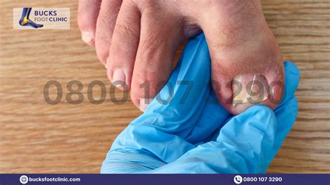 Side Of Toenail Hurts But Isn't Ingrown? Read This Blog!