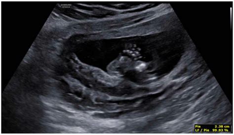 Prenatal Diagnosis of Neu–Laxova Syndrome