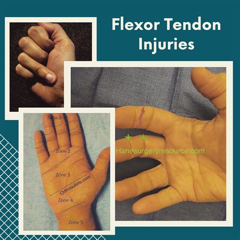 Flexor Digitorum Profundus Tendon