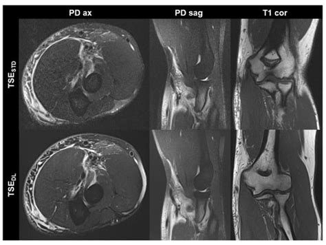 Faster Elbow MRI with Deep Learning Reconstruction—Assessment of Image ...