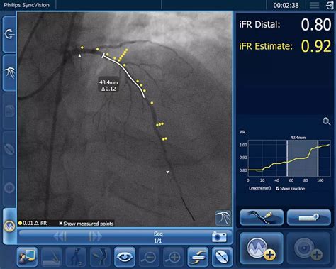 iFR Coronary Physiology - Philips