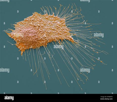 Esqueleto De Cáncer De Hueso