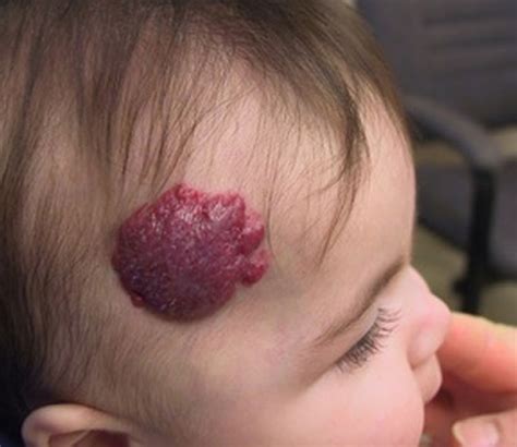 Vein Specialist in Thane | Varicose Veins Surgeon | EVLT