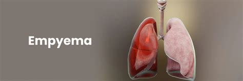 Understanding Empyema