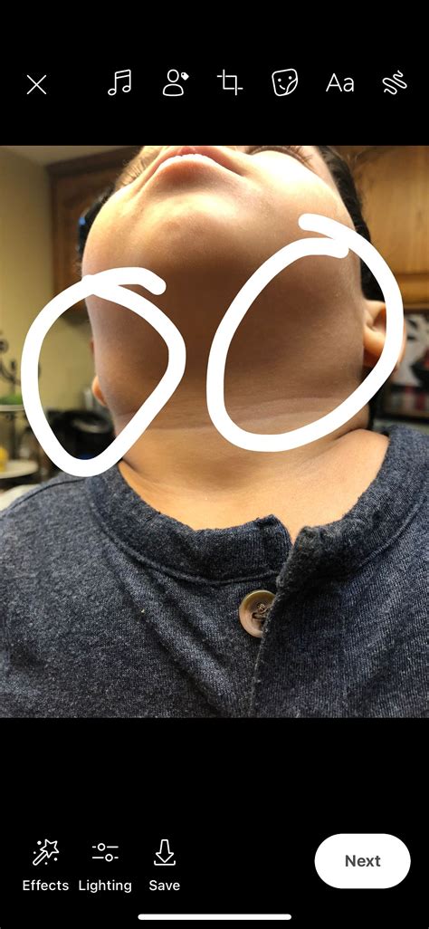 Lump on toddlers neck | BabyCenter