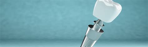 Step By Step Guide Divulging The Procedure of Dental Implant