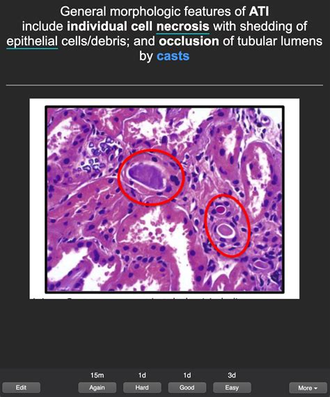 AnKing settings have new cards hard and good intervals at 1 day? : r ...