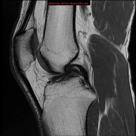 Bucket Handle Meniscus Tear Exercises at Ella Reibey blog