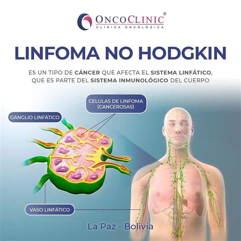 Linfoma No Hodgkin Linfoma No Hodgkin | Linfoma Difuso De Células B