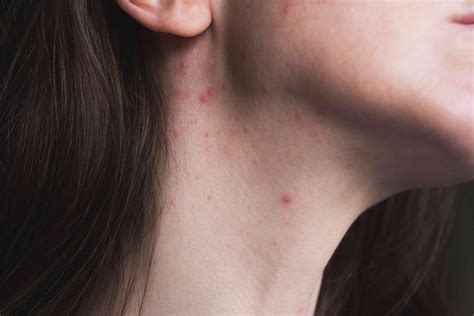 Why Do I Have a Rash on My Neck?