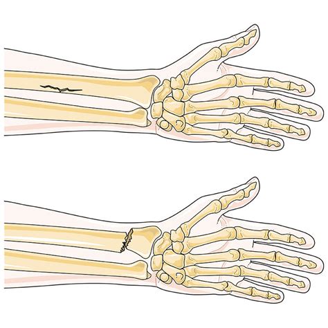 Radius Fracture 的图像结果