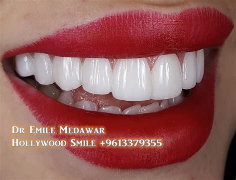 Hollywood Smile Lebanon | Emax Veneers Lebanon