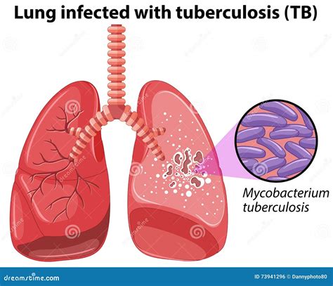 Tuberculosis Meaning