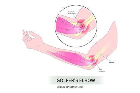 Golfing With Golfers Elbow