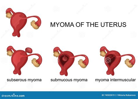 Myoma of the uterus stock vector. Illustration of gynaecology - 74502819