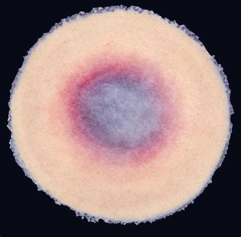 Image result for Deep Tissue Injuries