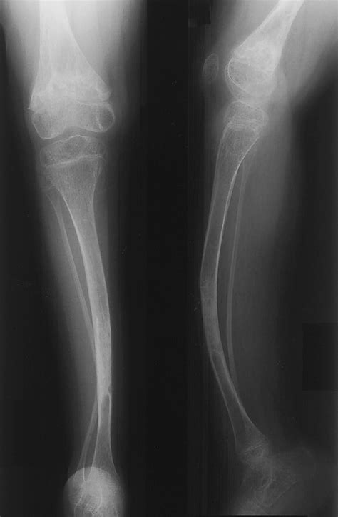 Osteogenesis Imperfecta (Brittle Bone Disease)