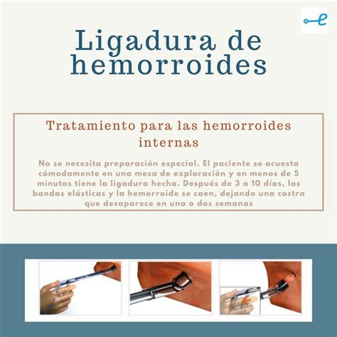 ¿Que es la ligadura con banda elástica de las hemorroides? - Clínica ...