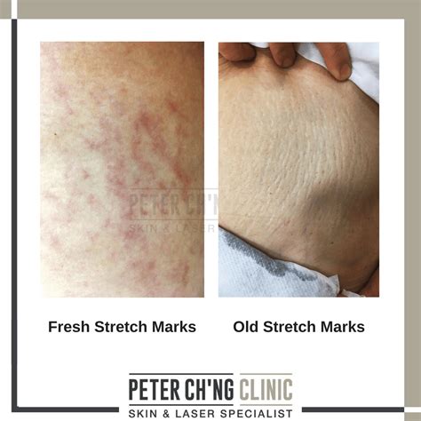 Top 5 Causes of these Annoying Stretch Marks on Our Skin | Peter Ch'ng Skin Specialist - KL ...