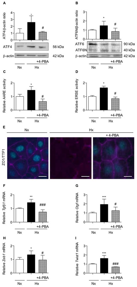 ER Stress is Involved in Epithelial-To-Mesenchymal Transition of ...