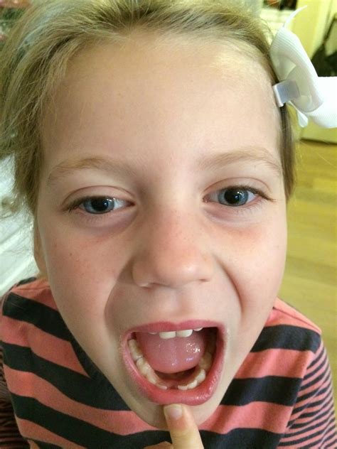 Image result for Lost Tooth