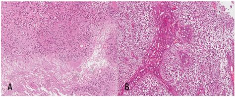 Histologic Definition of Enhancing Core and FLAIR Hyperintensity Region ...