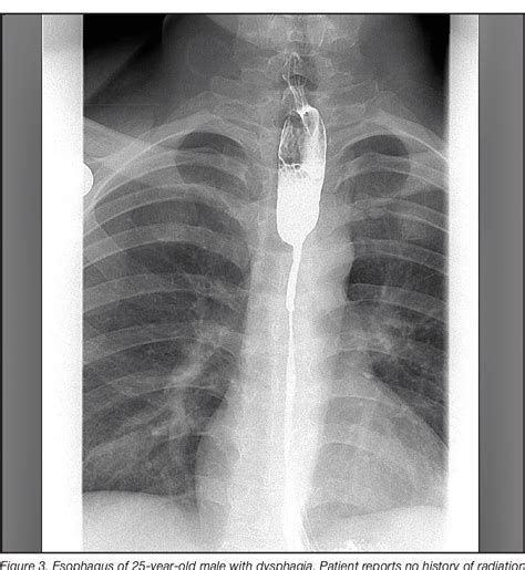 Image result for Modified Barium Swallow Video Example