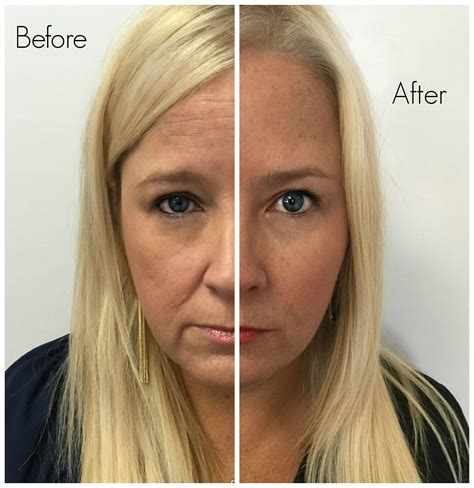 How to Get Rid of Wrinkles in 10 Days | Facial fillers, Botox eyes, Botox