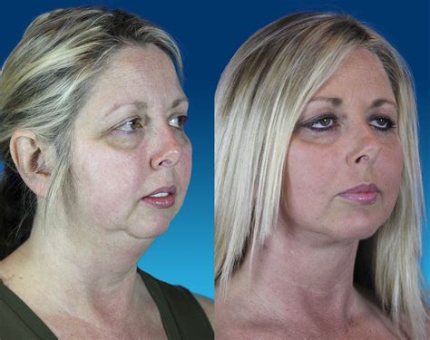 Facelift surgery results | Face lift surgery, Plastic surgery, Facial surgery