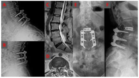 Stand-Alone Oblique Lumbar Interbody Fusion (OLIF) for the Treatment of ...