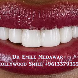 Direct Veneers | Composite Veneers Lebanon