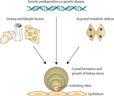 Are Kidney Stones Hereditary