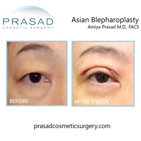 Recovery from Asian Blepharoplasty: How to Manage Swelling