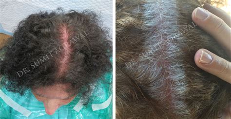 Female Hair Transplant