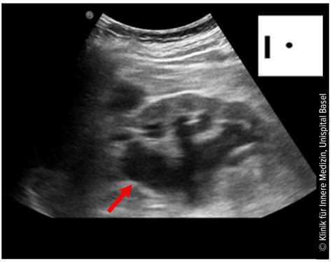 Point-of-Care-Ultraschall (POCUS): das moderne Stethoskop? - Allgemeine ...