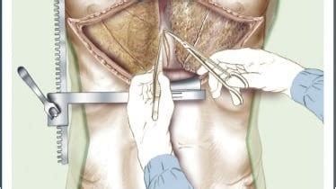 Image result for Thoracotomy Recovery