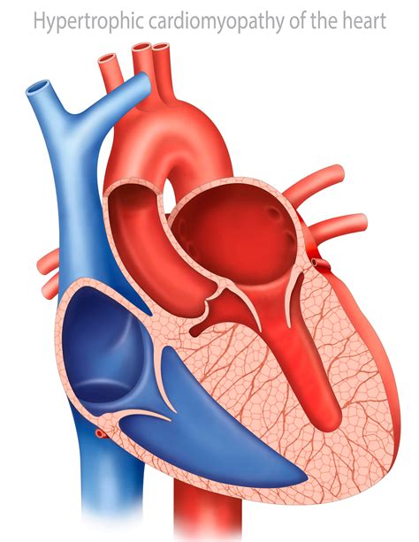 Hypertrophic cardiomyopathy