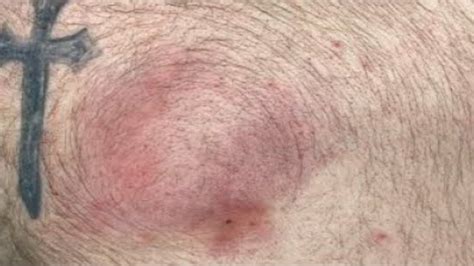 Image result for Giant Abscess Exploding On Back