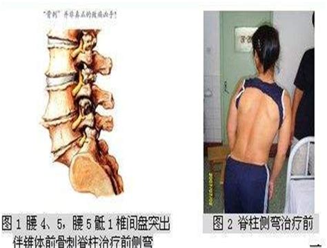 张天民教授针刀治疗腰椎间盘突出症案例分享