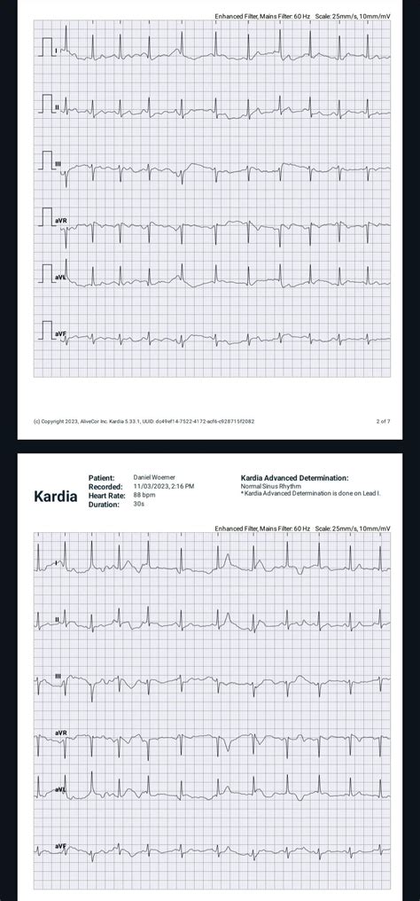 Please help chest tightness hard to breathe : r/ReadMyECG