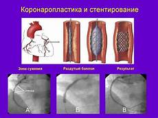 Можно ли летать при стенокардии - Лечение гипертонии