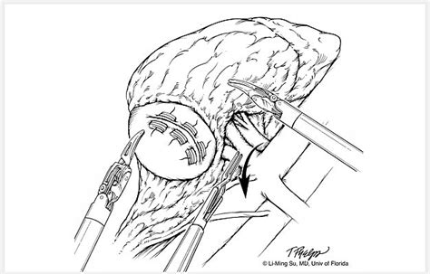 Image result for Robotic Partial Nephrectomy Video Animation